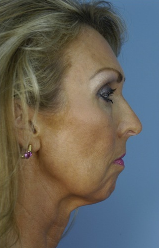 49 year old woman who wanted improvement of the lower face and neck 1287537