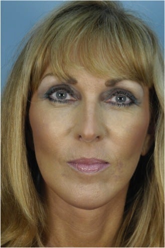 49 year old woman who wanted improvement of the lower face and neck after 1287537