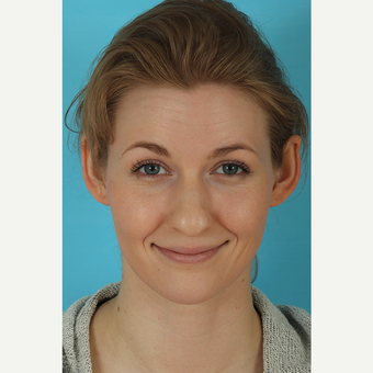 25-34 year old woman treated with Rhinoplasty before 3629430