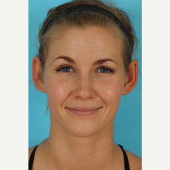25-34 year old woman treated with Rhinoplasty after 3629430