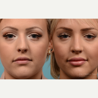 25-34 year old woman treated with Rhinoplasty before 3821353