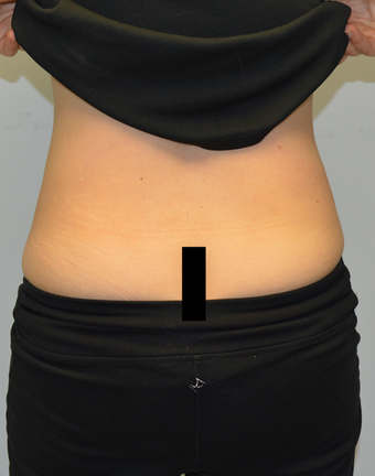 Coolsculpting treatment for love handles 12 weeks after one treatment after 1439709