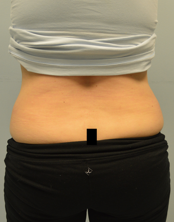 Coolsculpting treatment for love handles 12 weeks after one treatment before 1439709
