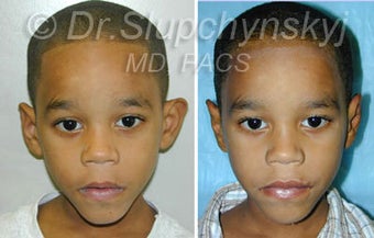 Otoplasty Plastic Surgery before 1117226