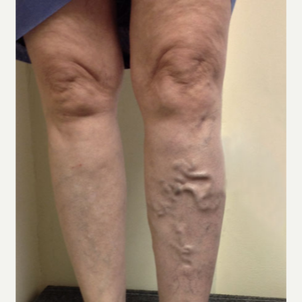 55-64 year old woman treated with EVLT before 3163881