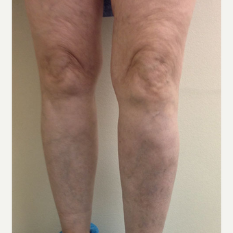 55-64 year old woman treated with EVLT after 3163881