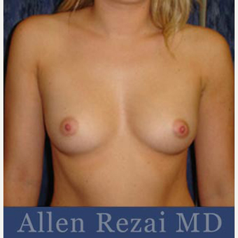 Bilateral Breast Augmentation - Pre- & 3 Years and 9 months Post-op before 3473964