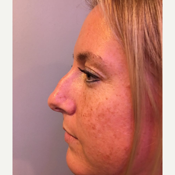 25-34 year old woman treated with Rhinoplasty before 3541080