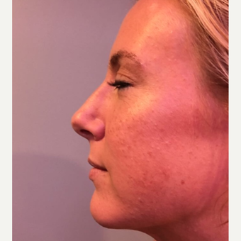 25-34 year old woman treated with Rhinoplasty after 3541080
