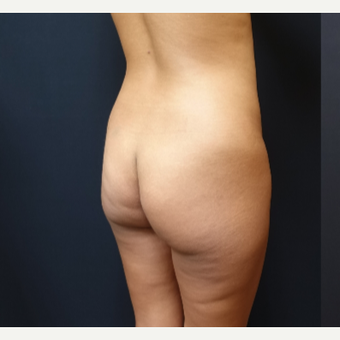 25-34 year old woman treated with Butt Lift before 3731810