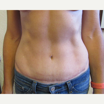 45-54 year old woman treated with Tummy Tuck after 3407137