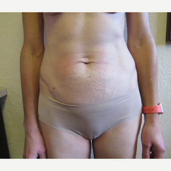 45-54 year old woman treated with Tummy Tuck before 3407137