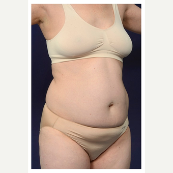 35-44 year old woman treated with Tummy Tuck before 3174267