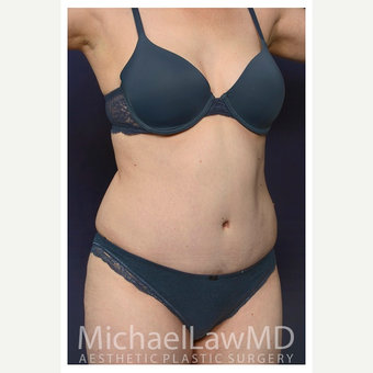 35-44 year old woman treated with Tummy Tuck after 3174267