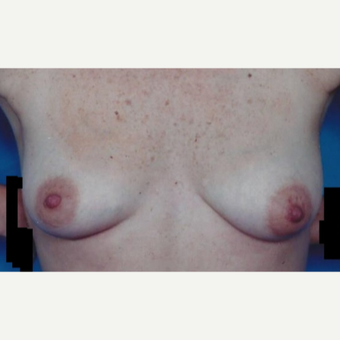 25-34 year old woman treated with Breast Augmentation before 3629394