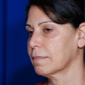 55-64 year old woman treated with Bellafill before 1956567