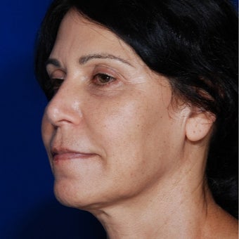 55-64 year old woman treated with Bellafill after 1956567