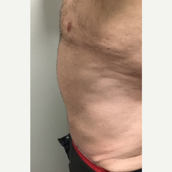 45-54 year old man treated with CoolSculpting after 3738064