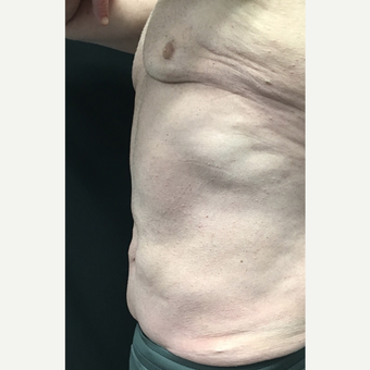 45-54 year old man treated with CoolSculpting before 3738064