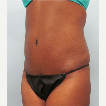45 year old woman treated with Tummy Tuck after 3680186