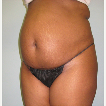 45 year old woman treated with Tummy Tuck before 3680186