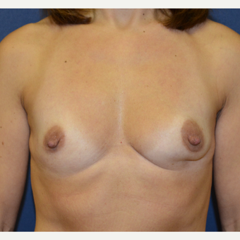 45-54 year old woman treated with Breast Reconstruction before 3136607