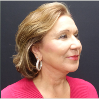 65-74 year old woman treated with Neck Lift after 3244948