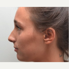 18-24 year old woman treated with Rhinoplasty before 3747732
