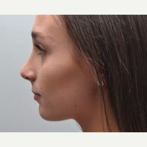 18-24 year old woman treated with Rhinoplasty after 3747732