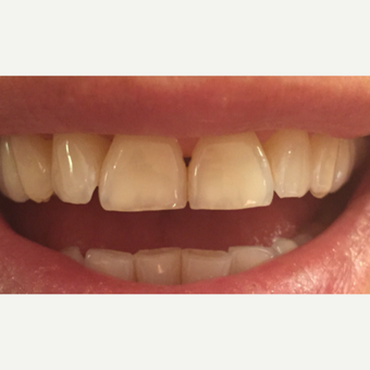 25-34 year old woman treated with Teeth Whitening before 3624457