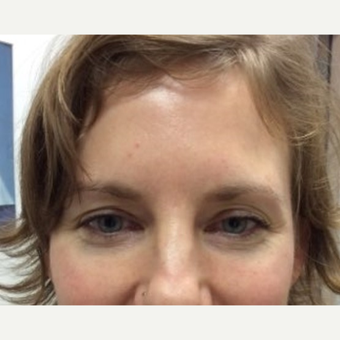 35-44 year old woman treated with Eye Bags Treatment after 3646479