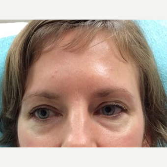 35-44 year old woman treated with Eye Bags Treatment before 3646479