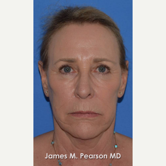 55-64 year old woman treated with Facelift before 3802271
