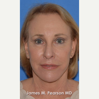 55-64 year old woman treated with Facelift after 3802271