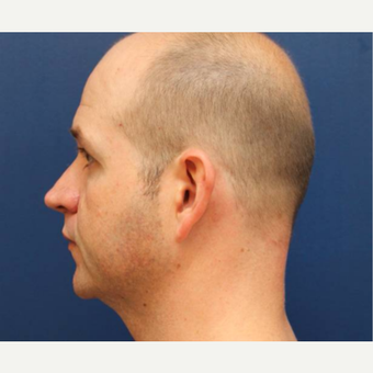 36 year old male who had a chin implant placed for a more masculine jawline before 2906353