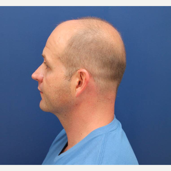 36 year old male who had a chin implant placed for a more masculine jawline after 2906353