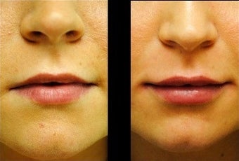 Lip Augmentation before 977539