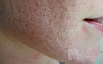 Synergy treatments for acne scars- Erbium and CO2 laser before 1440958