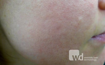 Synergy treatments for acne scars- Erbium and CO2 laser after 1440958