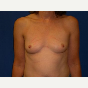 65-74 year old woman treated with Breast Lift before 3009184