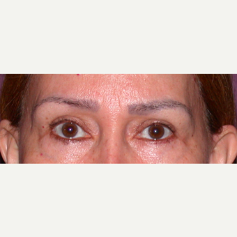Eyelid Surgery before 3123667