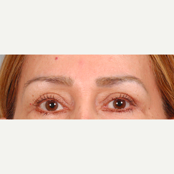 Eyelid Surgery after 3123667