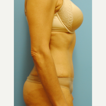 45-54 year old woman treated with Tummy Tuck after 3061434