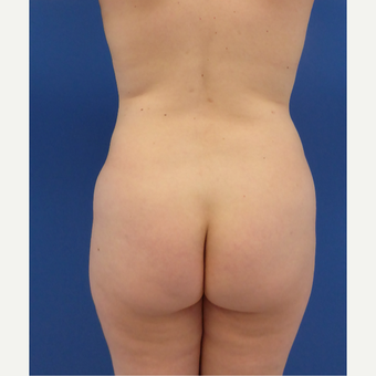27 y/o female - 1500cc per side Lipo abdomen, flanks, back with fat transfer to the buttocks before 3433783