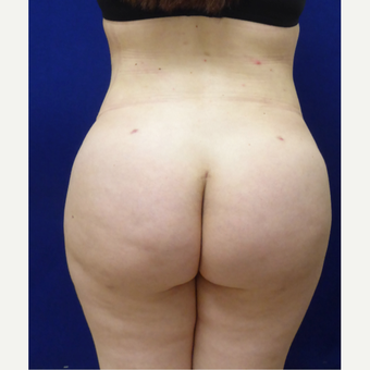 27 y/o female - 1500cc per side Lipo abdomen, flanks, back with fat transfer to the buttocks after 3433783