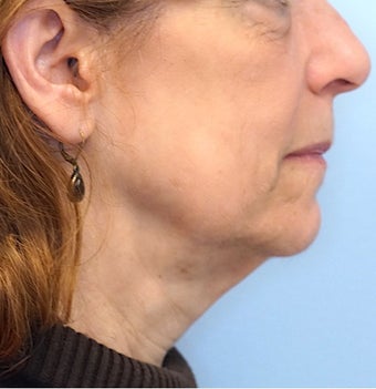 65-74 year old woman treated with Facelift before 2986659