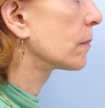 65-74 year old woman treated with Facelift after 2986659