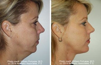 Neck Lift, Neck Lipo, Chin Implant before 212307