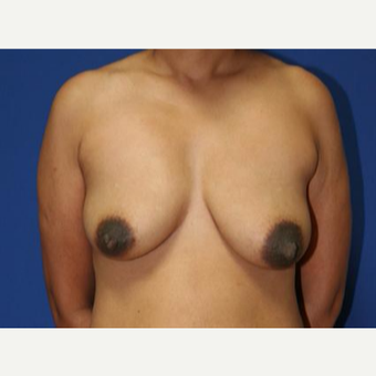45-54 year old woman treated with Breast Reduction before 3032929