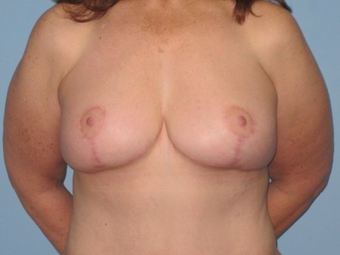 This patient had Abdominoplasty and VASER LipoSelection of abdomen, flanks, axilla and a Mastopexy. after 963260